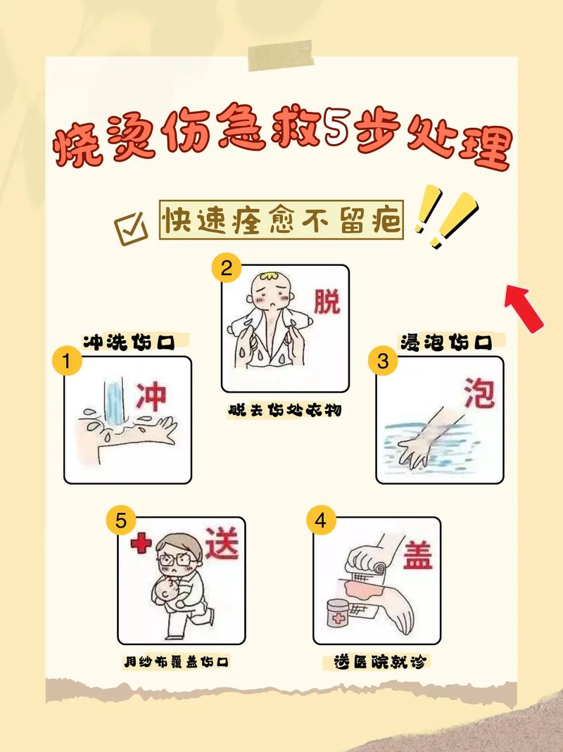 烫伤紧急处理?冲冷水15分钟以上!